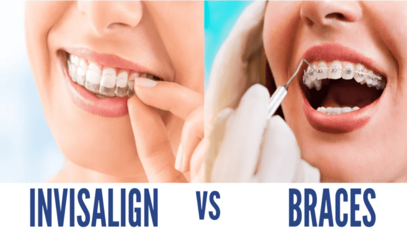 Invisalign and metal braces