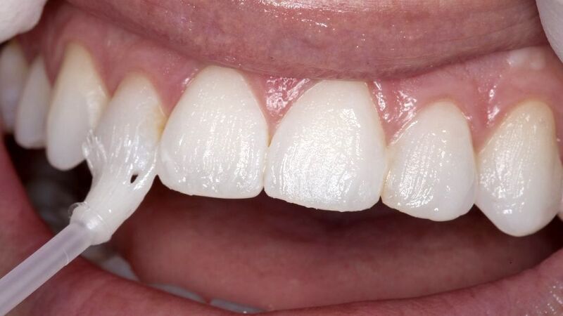 Teeth Need Fluoride