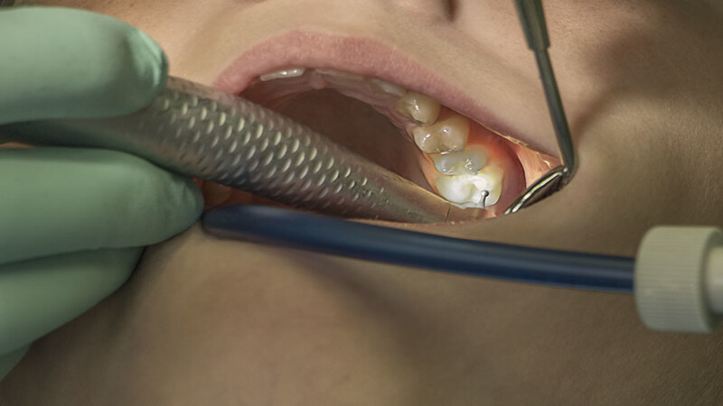 Dental Condition