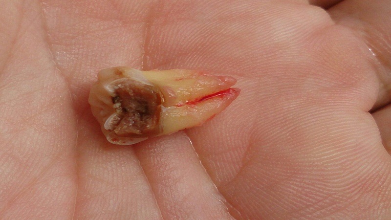Teeth Decay