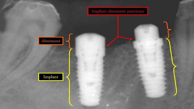 Dental Implant Problems
