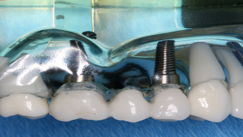 Dental Implants and Dental Bridges