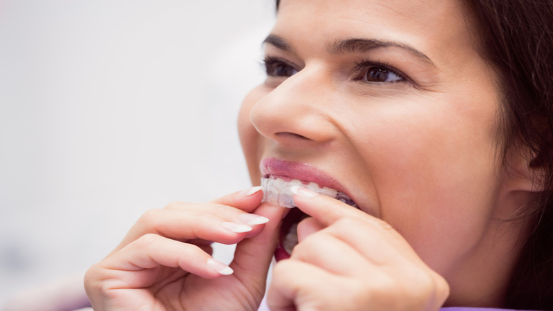 What Can I Expect from Getting Invisalign in Sheffield?