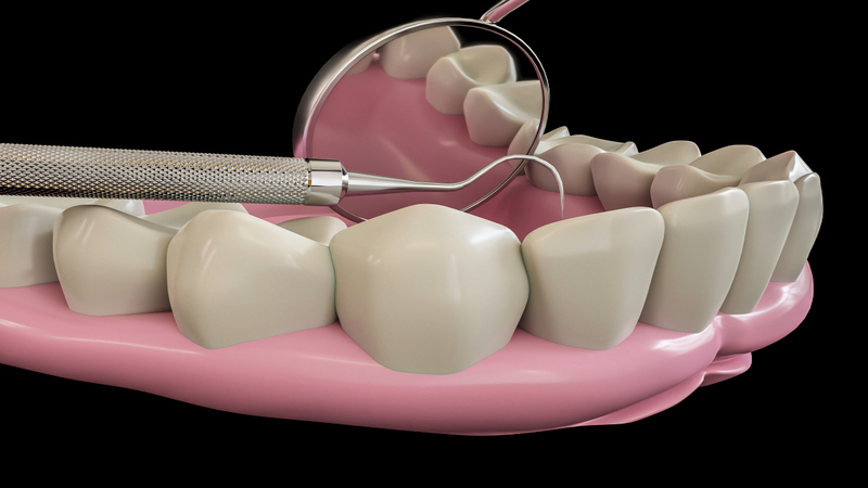 Step-by-Step Guide to Getting a Dental Bridge